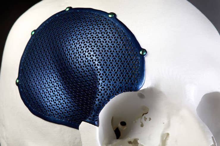 Materialise titanium implant