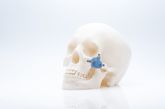 A bioresorbable zygomatic implant 3D-printed using hydroxy apatite.