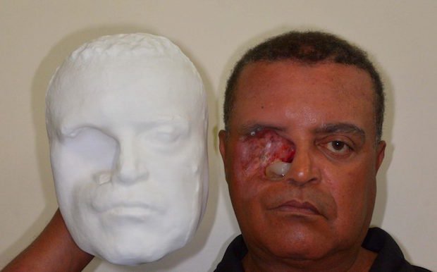 Brazilian cancer survivor becomes first to receive 3D-printed face  prosthesis using smartphone - TCT Magazine